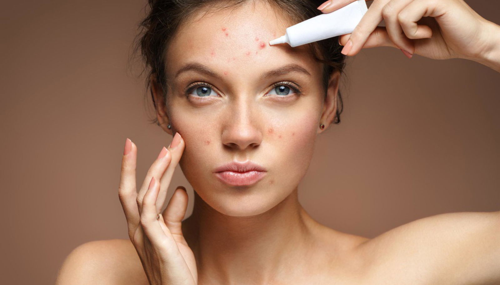 acne-causes-and-acne-treatment-model