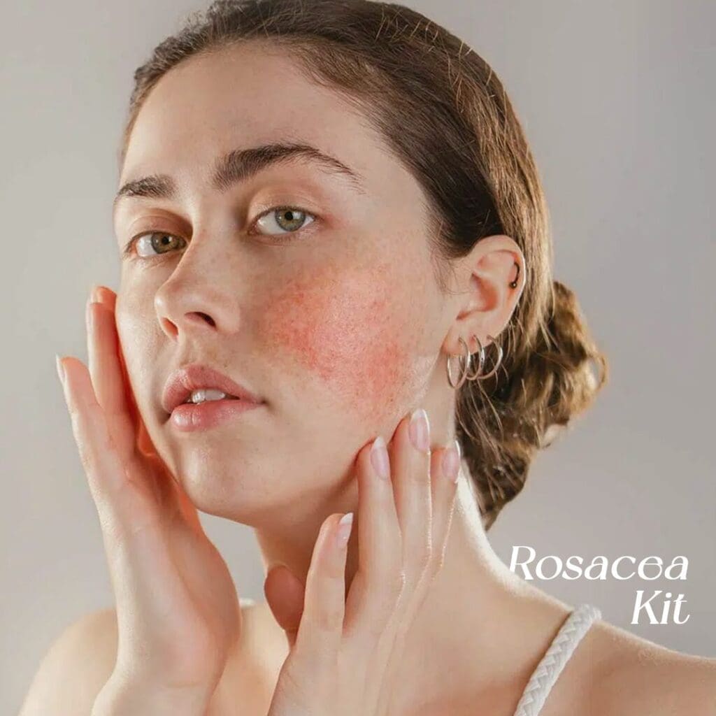 Rosacea